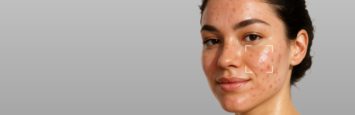 Acne-Prone Skin