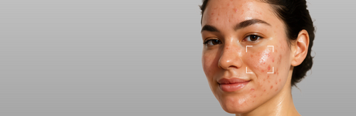 Acne-Prone Skin