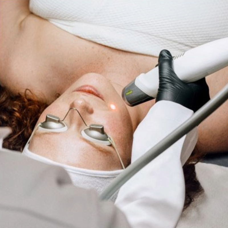 Laser Skin Rejuvenation