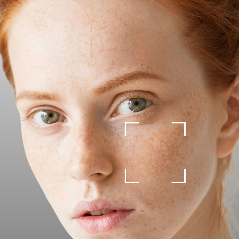 Discoloration